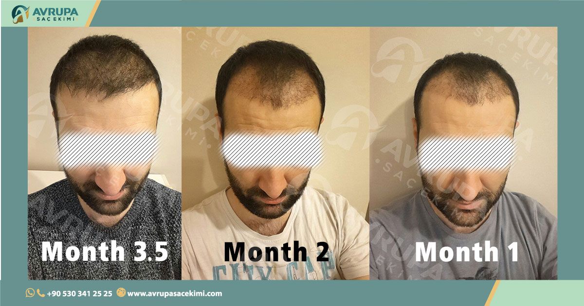 نتائج زراعة الشعر الجدول الزمني Hair Transplant In Turkey Before And After