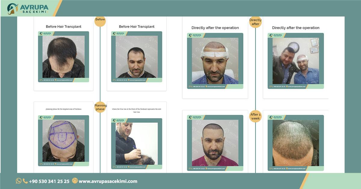 Hair transplant results by timeline
