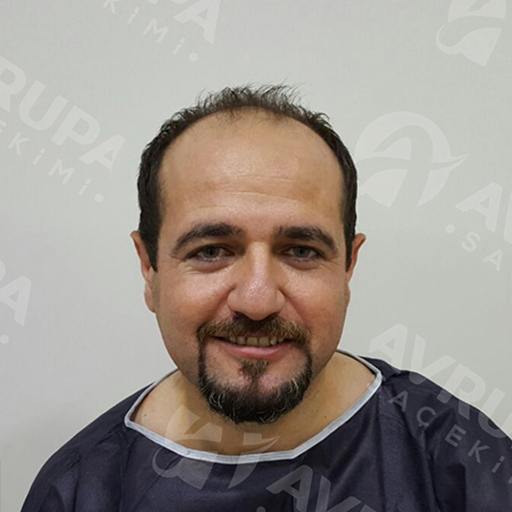 Before & After Hair Transplant In Turkey
