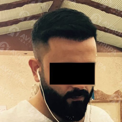 Before & After Hair Transplant In Turkey