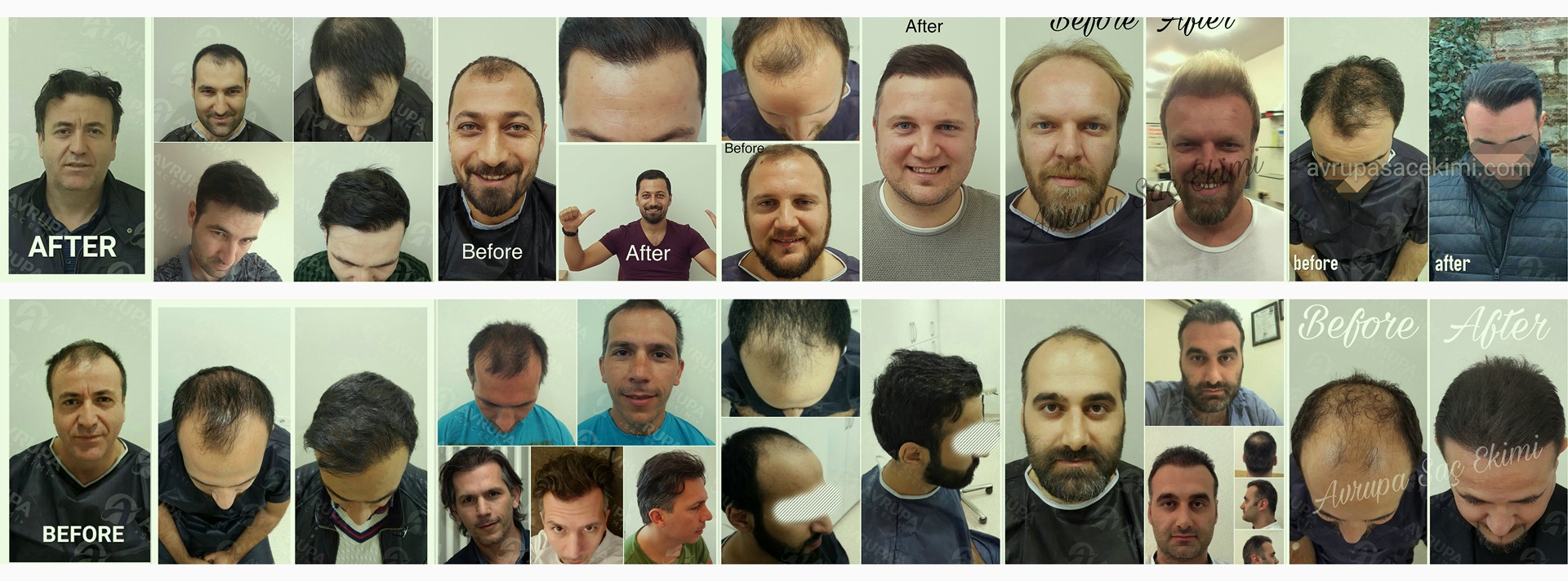 Avrupa Saç Ekimi Hair Transplant